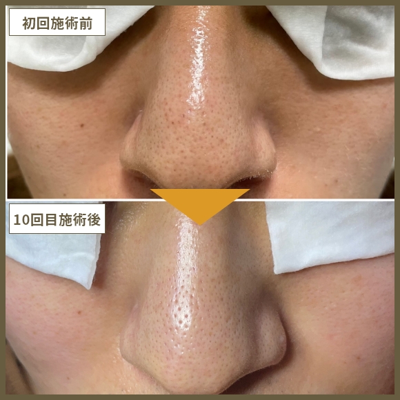 毛穴洗浄コース