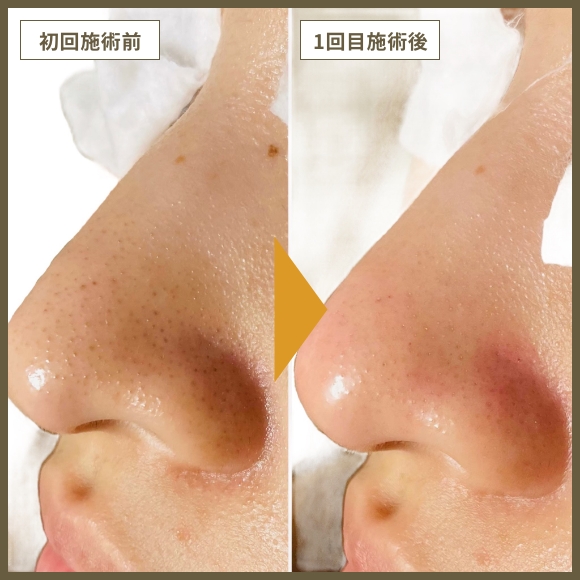 毛穴洗浄コース