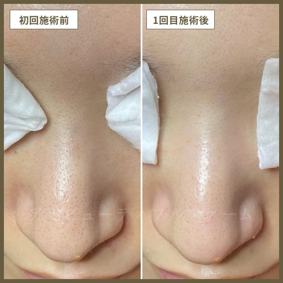 毛穴洗浄コース